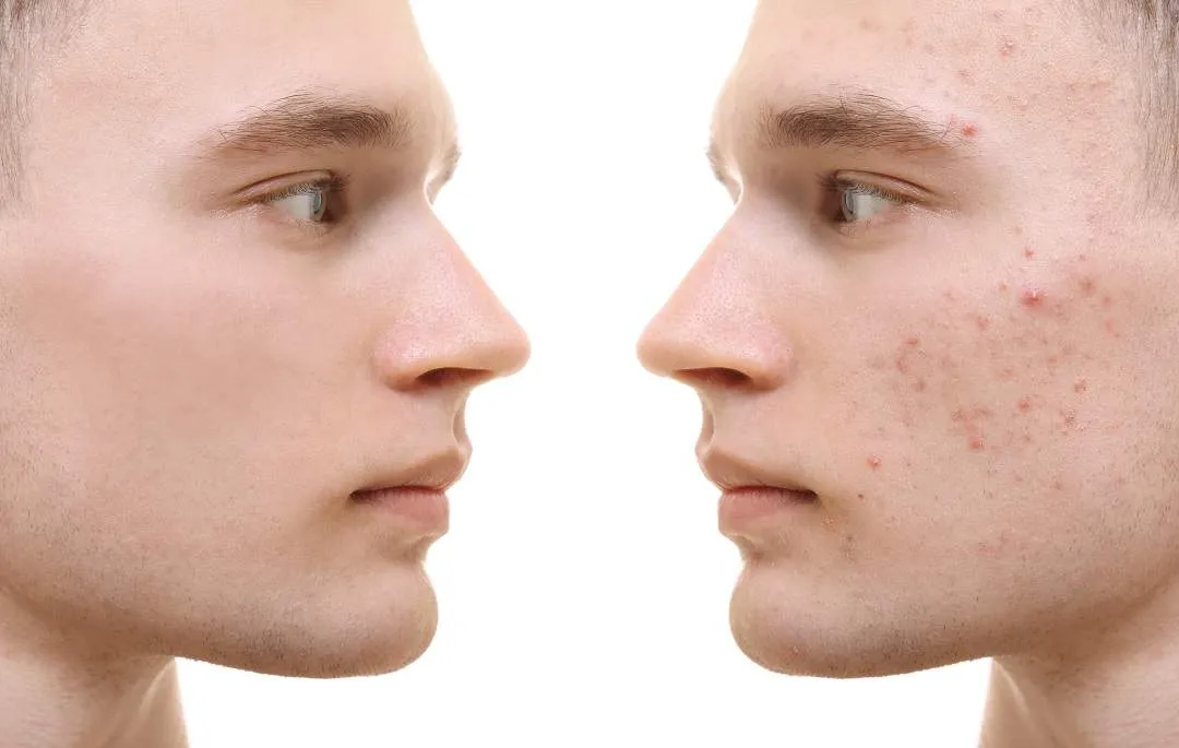 Why is Venus Versa Good For Acne Treatments