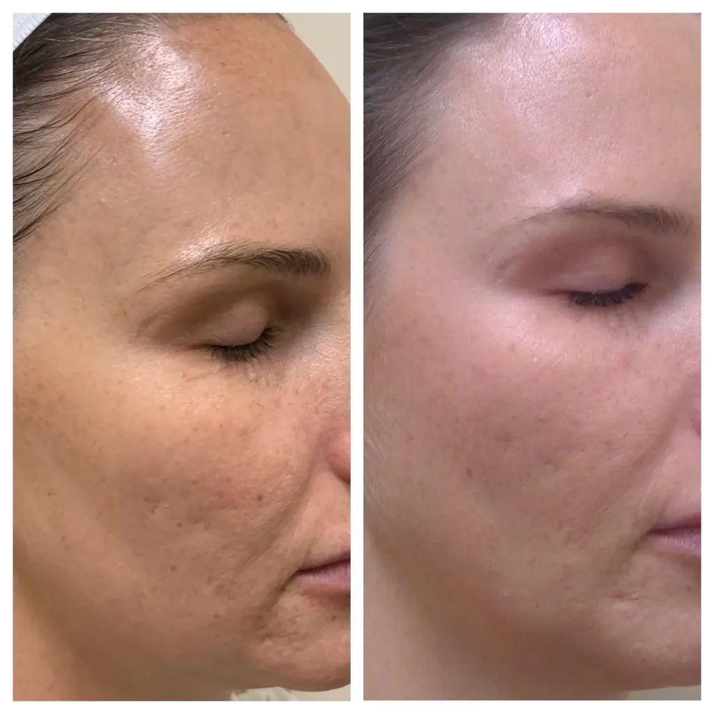 tribella 2
