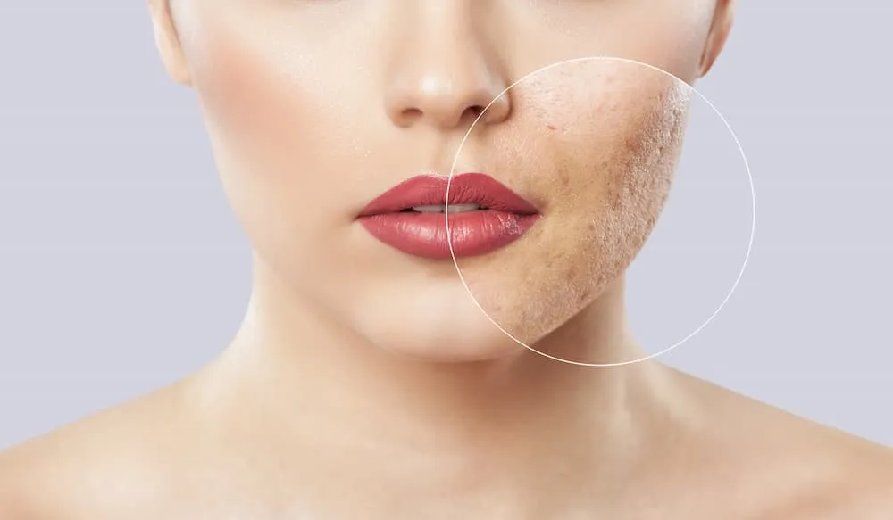 FocalPointSalonBeautyTreatmentAcneScars