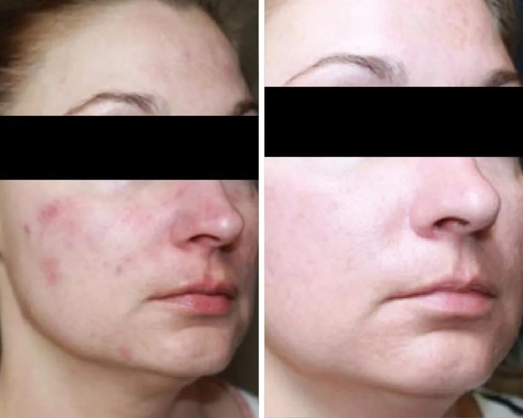 Acne 2 B&A