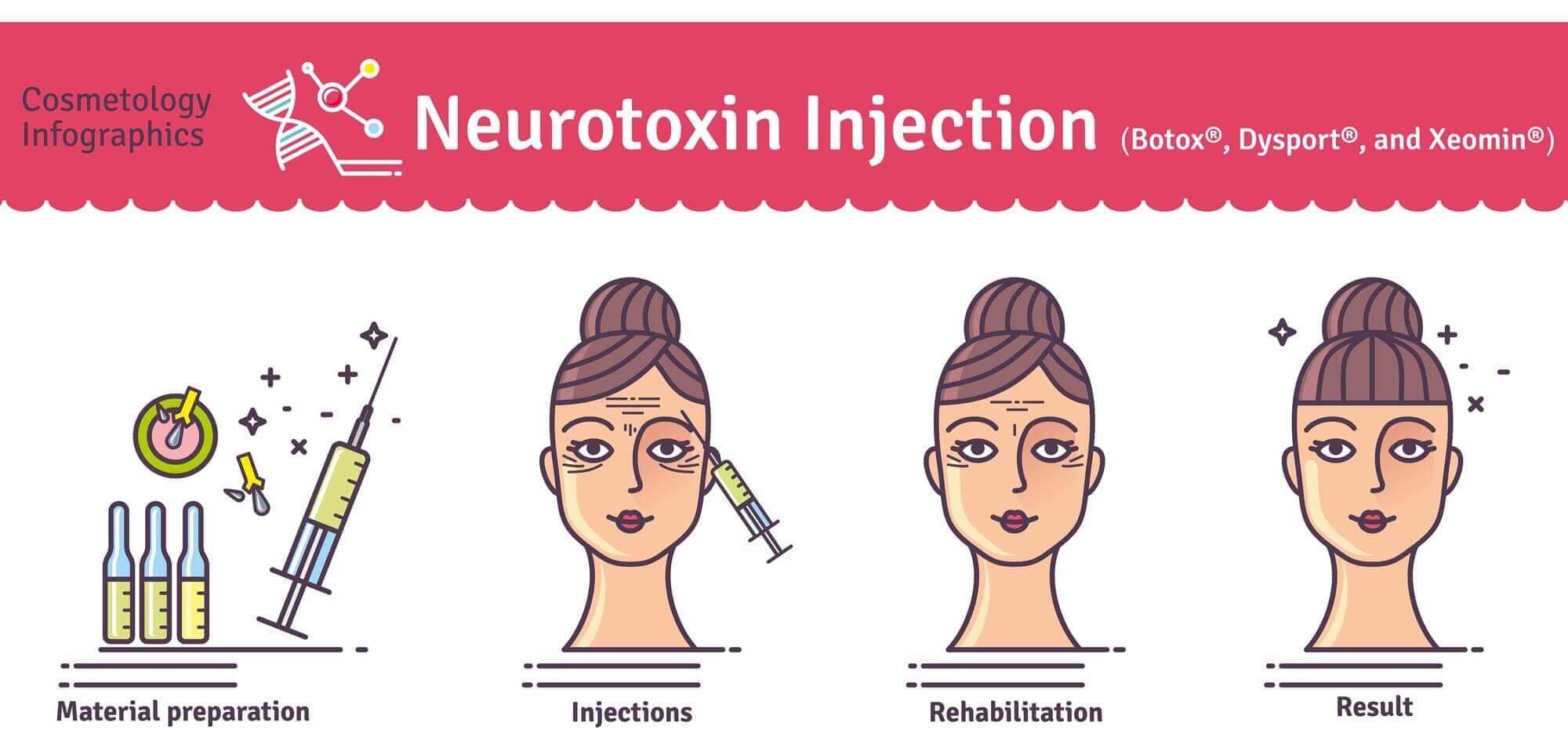 Botox-Diagram