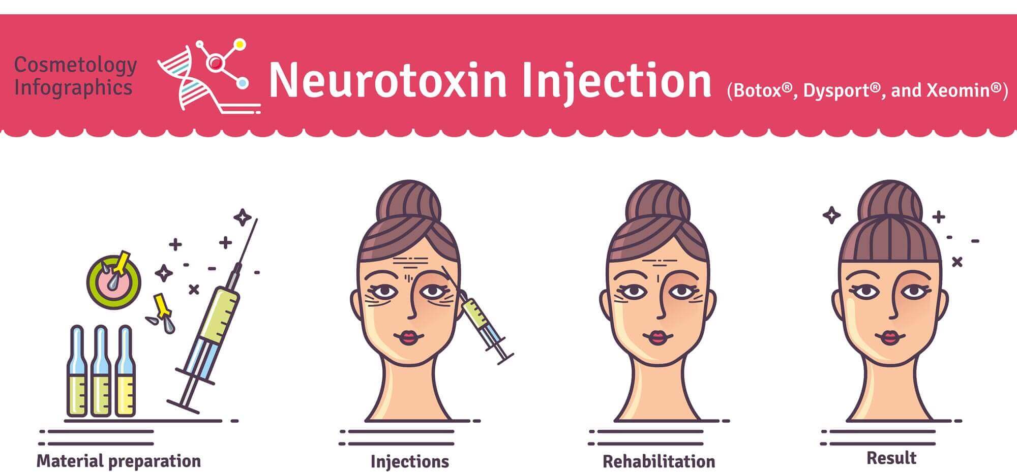 Botox Diagram Focal Point Salon & Spa