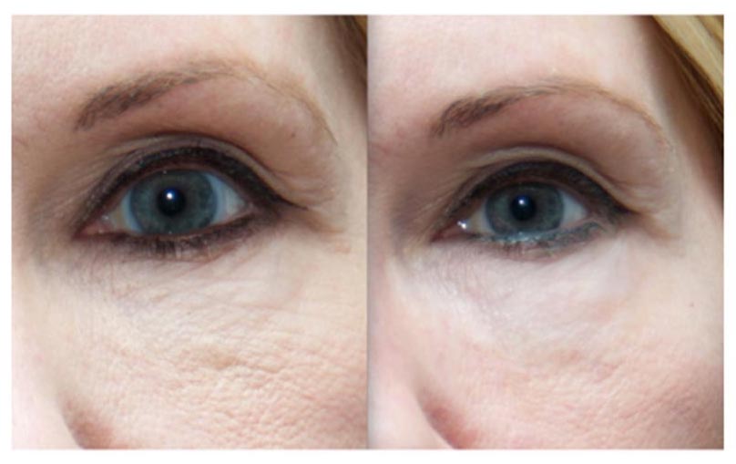 focal-point-salon-_0002_Micro Fine Lines – Under Eye