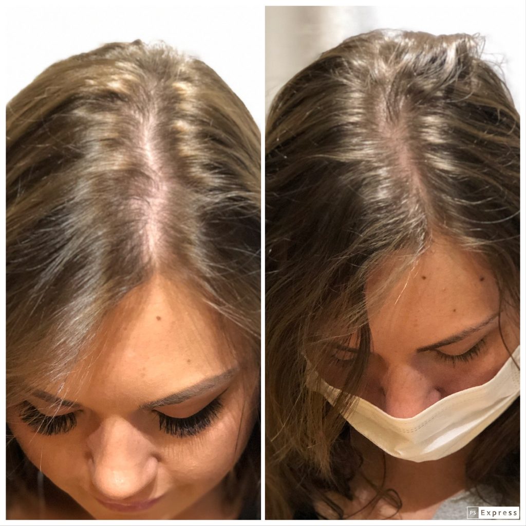 Hair Regeneration In Phoenix Az 85054 Focal Point Salon And Spa 9576