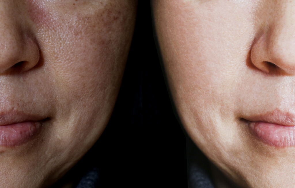 Face with open pores and melasma before and after make up or treatment concept.