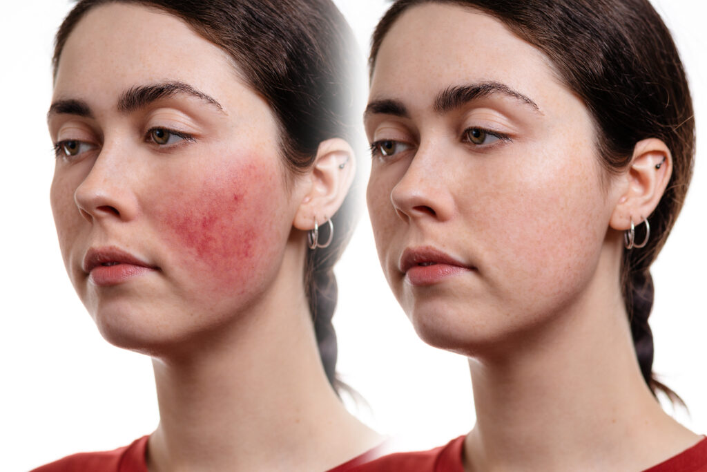 Two close up portraits of a young Caucasian woman with rosacea on her cheeks. before and after. White background. The concept of rosacea and inflammation on the face