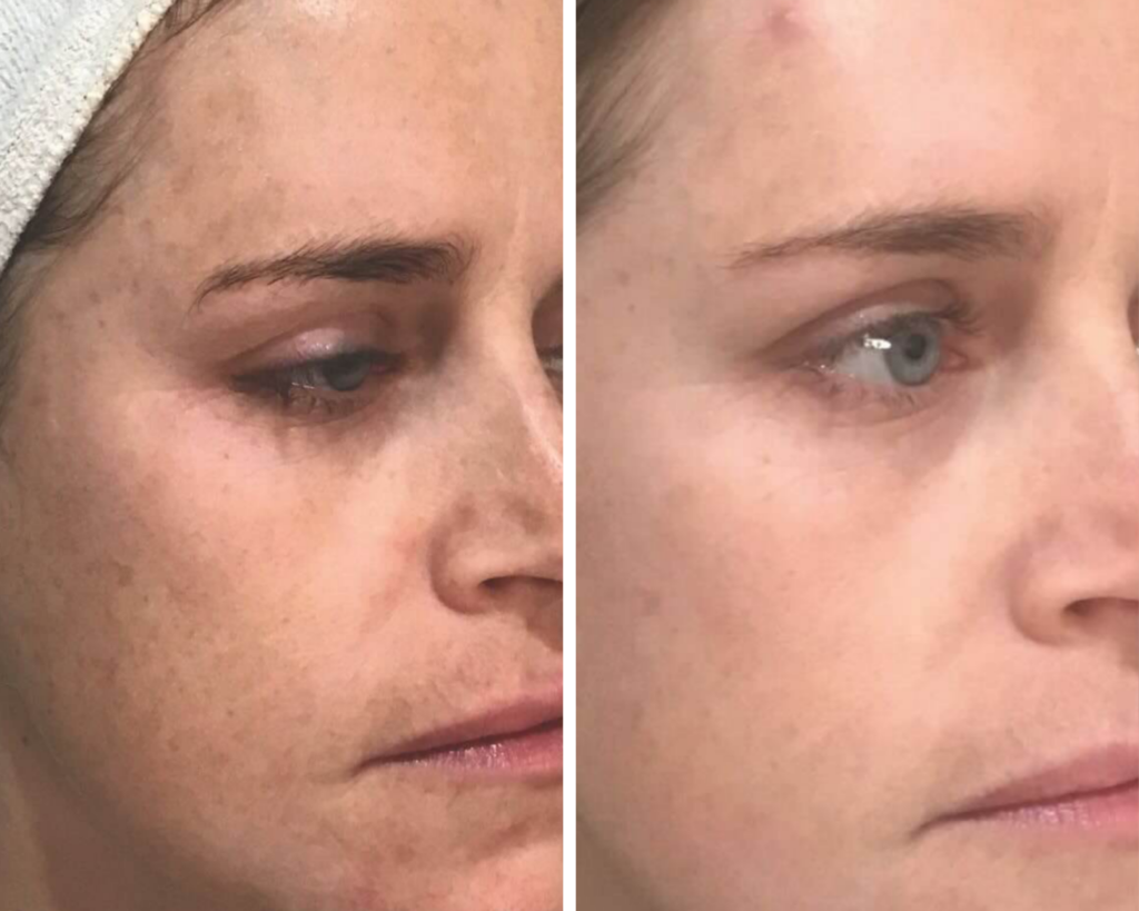 Melasma B&A