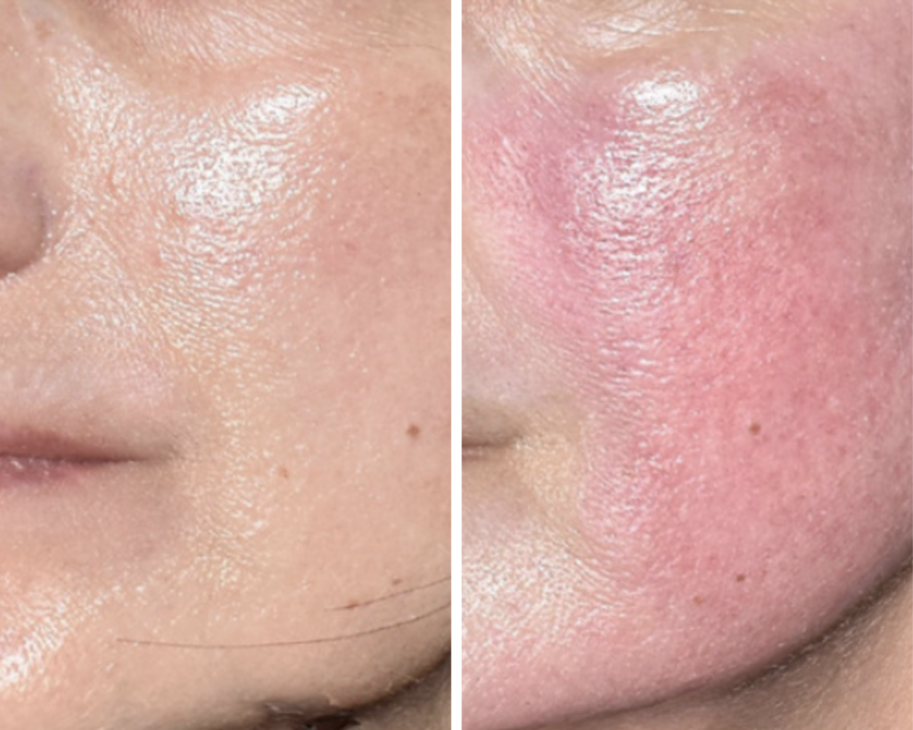 Rosacea B&A