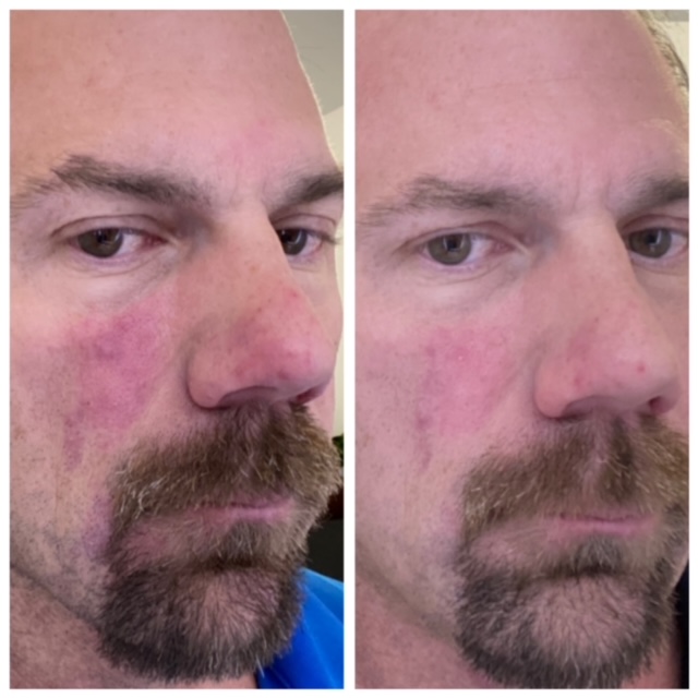 Rosacea Laser Treatment in Phoenix AZ AdvaTx Focal Point